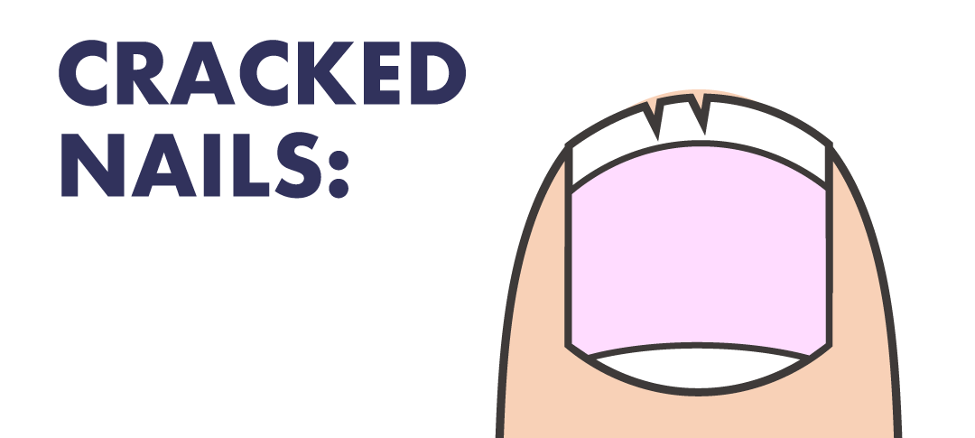 なぜ、爪が縦に割れる